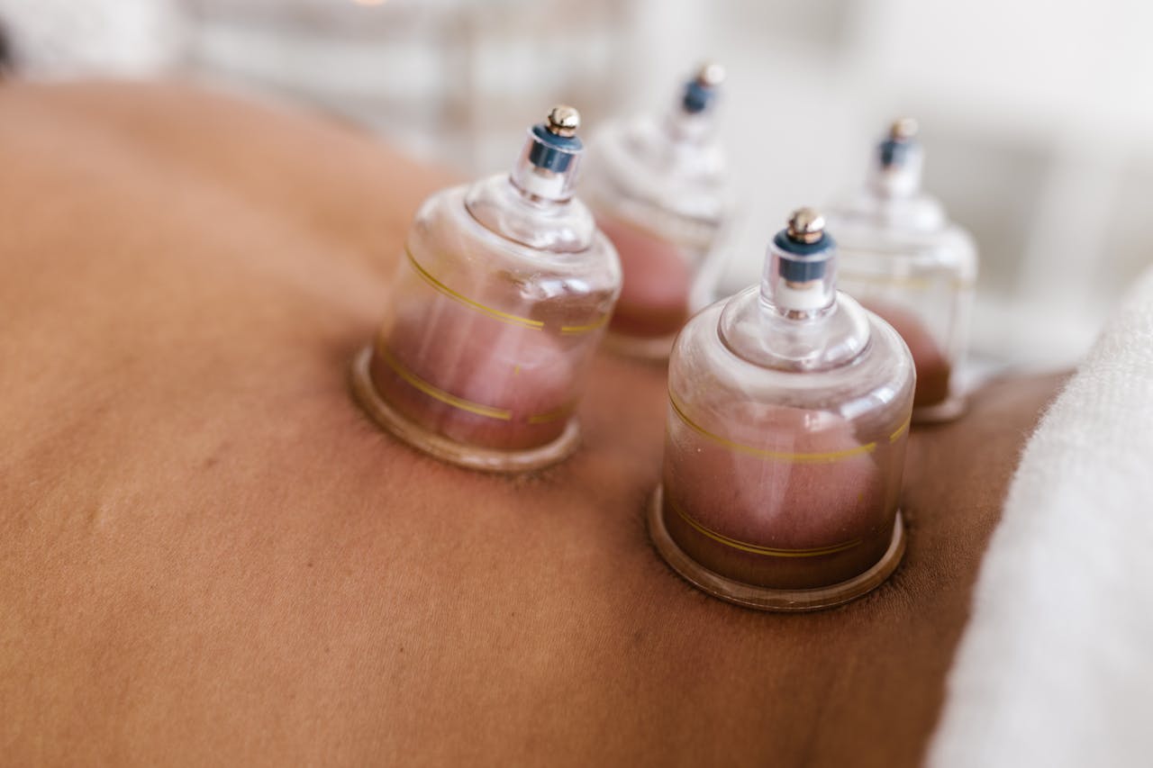 gallery-3 Detailed image of cupping therapy on a person's back, showcasing alternative medicine practice.